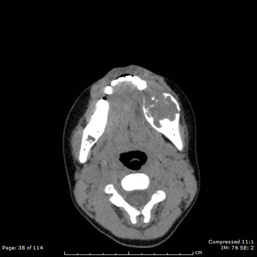 File:Central giant cell granuloma (Radiopaedia 45612-49754 Axial non-contrast 19).jpg