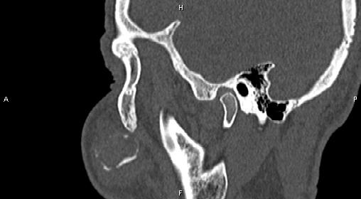 File:Central giant cell granuloma (Radiopaedia 83346-97761 Sagittal bone window 9).jpg