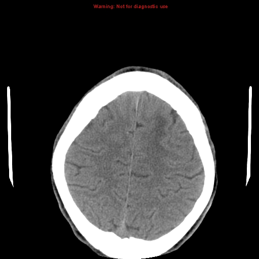 File:Central nervous system vasculitis (Radiopaedia 8410-9234 Axial non-contrast 22).jpg