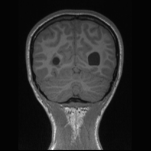 Central neurocytoma (Radiopaedia 37664-39557 Coronal T1 21).png