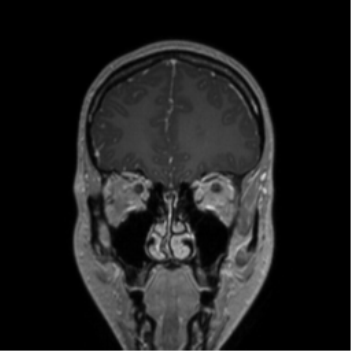 Central neurocytoma (Radiopaedia 37664-39557 Coronal T1 C+ 70).png