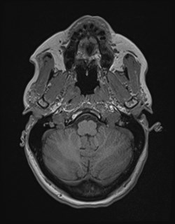 Central neurocytoma (Radiopaedia 84497-99872 Axial T1 43).jpg