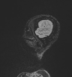 Central neurocytoma (Radiopaedia 84497-99872 Sagittal Flair + Gd 21).jpg
