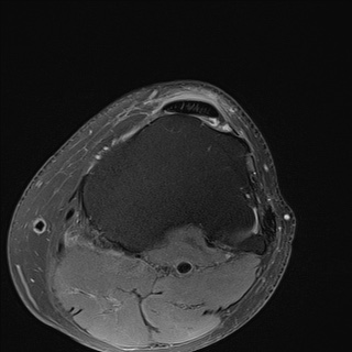File:Central osteophyte (Radiopaedia 72592-83151 Axial PD fat sat 29).jpg