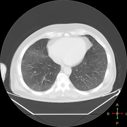 File:Centrilobular emphysema - with superimposed infection (Radiopaedia 24389-24683 lung window 21).jpg