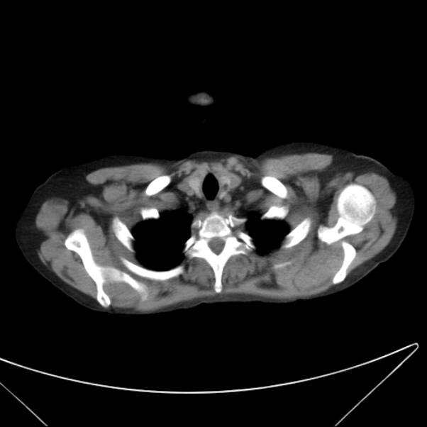 Centrilobular pulmonary emphysema (Radiopaedia 24495-24789 Axial non-contrast 3).jpg