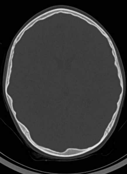 File:Cerebellar abscess (Radiopaedia 73727-84527 Axial bone window 40).jpg