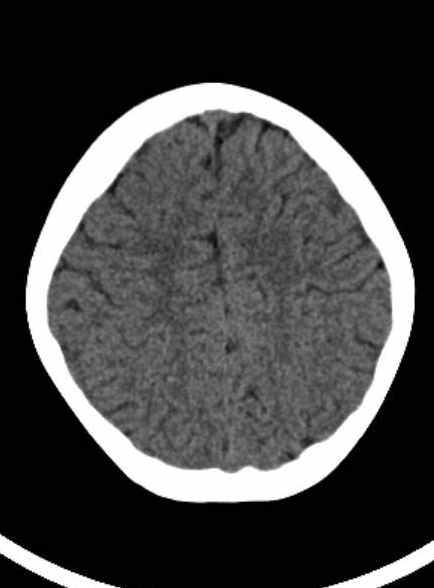 Cerebellar abscess (Radiopaedia 73727-84527 Axial non-contrast 52).jpg