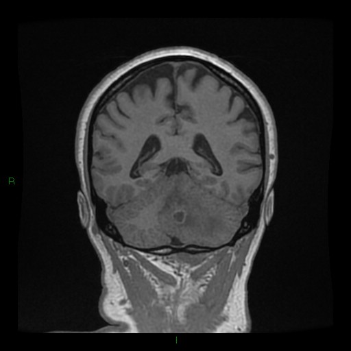 File:Cerebellar abscess (Radiopaedia 78135-90678 Coronal T1 C+ 112).jpg