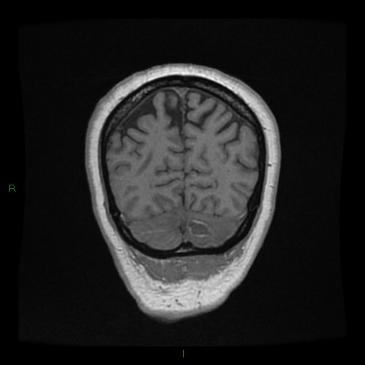 File:Cerebellar abscess (Radiopaedia 78135-90678 Coronal T1 C+ 141).jpg