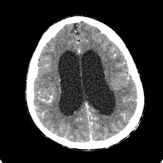Cerebellar abscess secondary to mastoiditis (Radiopaedia 26284-26412 Axial C+ delayed 103).jpg