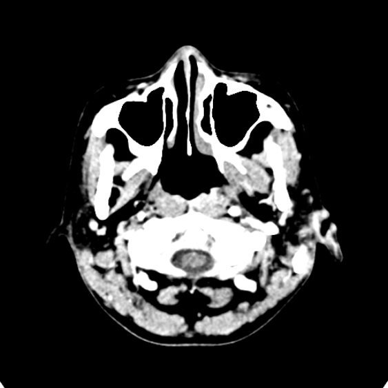 Cerebellar abscess secondary to mastoiditis (Radiopaedia 26284-26412 Axial C+ delayed 4).jpg