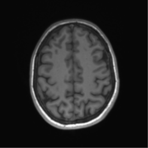 Cerebellar agenesis with hypoplastic pons (pontocerebellar hypoplasia) (Radiopaedia 57224-64138 Axial T1 58).png