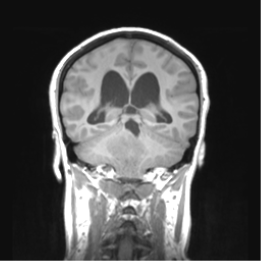 Cerebellar ependymoma complicated by post-operative subdural hematoma (Radiopaedia 83322-97736 Coronal T1 36).png
