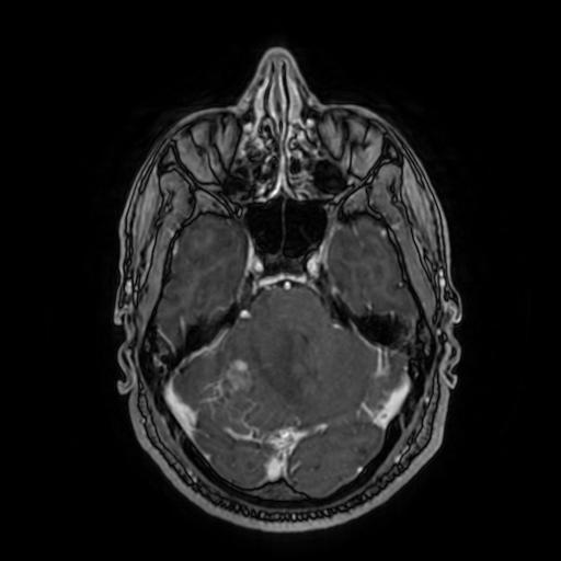 Cerebellar hemangioblastoma (Radiopaedia 88055-104622 Axial T1 C+ 64).jpg