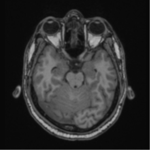 Cerebellar hemangioblastomas and pituitary adenoma (Radiopaedia 85490-101176 Axial T1 27).png