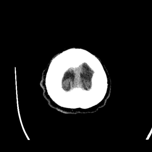 Cerebellar hemorrhage (Radiopaedia 27193-27359 Axial non-contrast 54).jpg