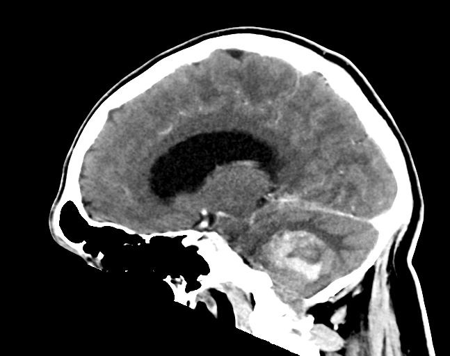 File:Cerebellar hemorrhage (Radiopaedia 37000-38671 Sagittal C+ 16).png