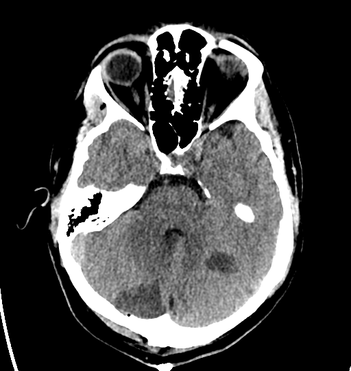 File:Cerebellar infarct due to vertebral artery dissection with posterior fossa decompression (Radiopaedia 82779-97031 Axial non-contrast 10).png