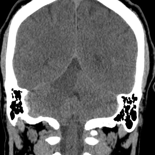 Cerebellar infarction (Radiopaedia 16625-16327 Coronal non-contrast 24).jpg
