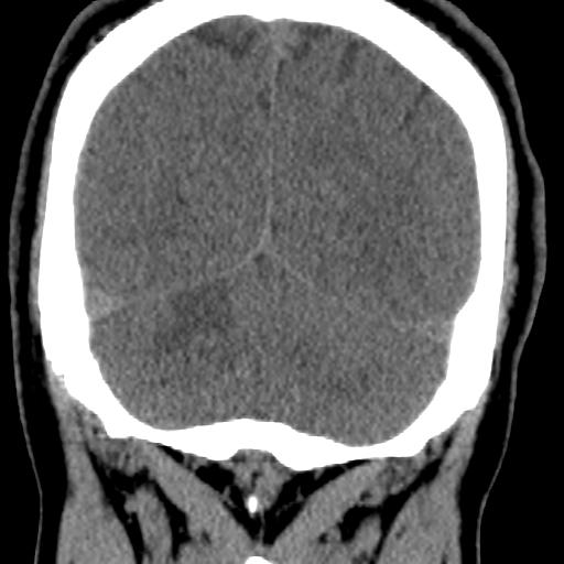 Cerebellar infarction (Radiopaedia 16625-16327 Coronal non-contrast 33).jpg