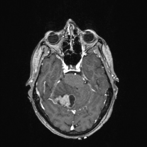 Cerebellar metastases (Radiopaedia 24038-24249 Axial T1 C+ 30).jpg