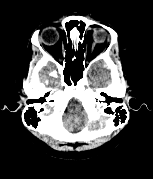 Cerebellar metastases - colorectal adenocarcinoma (Radiopaedia 40947-43652 Axial non-contrast 10).png