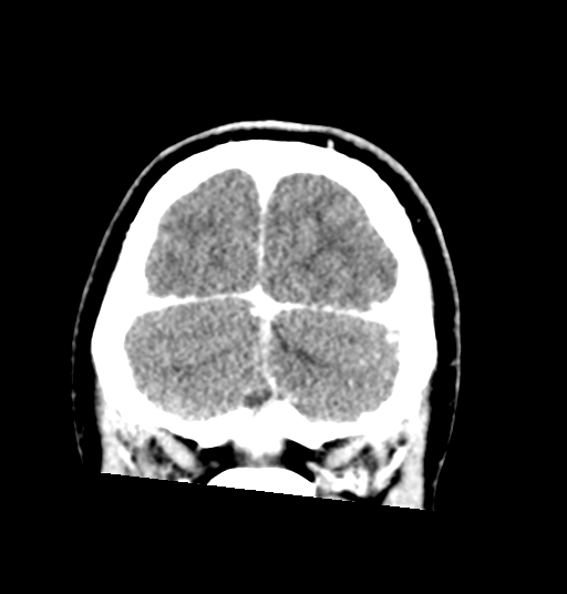 Cerebellar metastases - colorectal adenocarcinoma (Radiopaedia 40947-43652 Coronal C+ 80).png