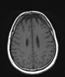 File:Cerebellar metastasis (Radiopaedia 54578-60810 Axial T1 27).png