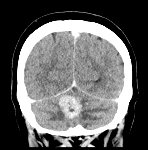 Cerebellar metastasis (Radiopaedia 54578-60812 Coronal C+ 49).png