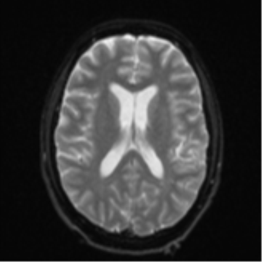 Cerebellar metastasis - adenocarcinoma lung (Radiopaedia 63184-71715 Axial DWI 18).png