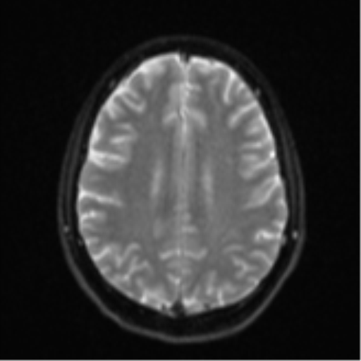 Cerebellar metastasis - adenocarcinoma lung (Radiopaedia 63184-71715 Axial DWI 21).png
