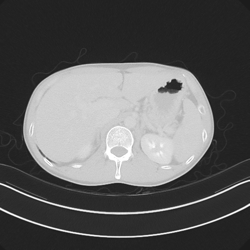 Cerebellar metastasis - adenocarcinoma lung (Radiopaedia 63184-71717 Axial lung window 69).png