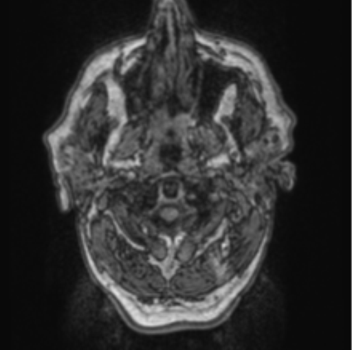 Cerebellar metastasis from lung adenocarcinoma (Radiopaedia 86690-102829 Axial T1 3).png