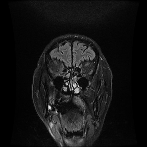 File:Cerebellar metastasis of pulmonary adenocarcinoma, cavernous venous malformation, and developmental venous anomaly (Radiopaedia 85827-101661 Coronal FLAIR 8).jpg