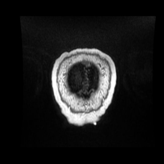 File:Cerebellar metastasis of pulmonary adenocarcinoma, cavernous venous malformation, and developmental venous anomaly (Radiopaedia 85827-101661 Coronal T1 C+ 10).jpg