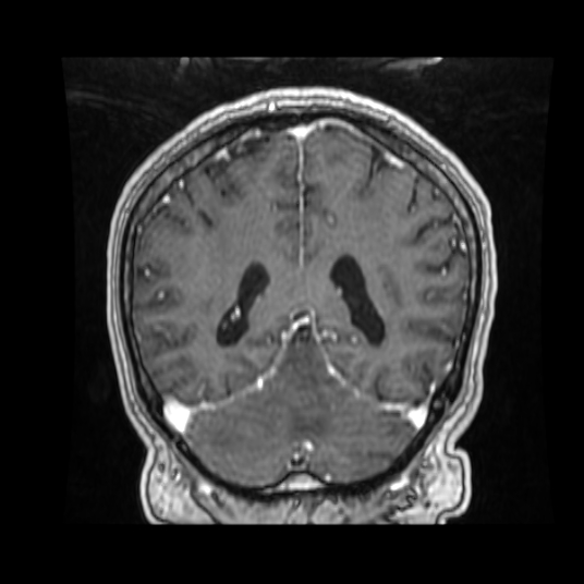 Cerebellar metastasis of pulmonary adenocarcinoma, cavernous venous malformation, and developmental venous anomaly (Radiopaedia 85827-101661 Coronal T1 C+ 36).jpg