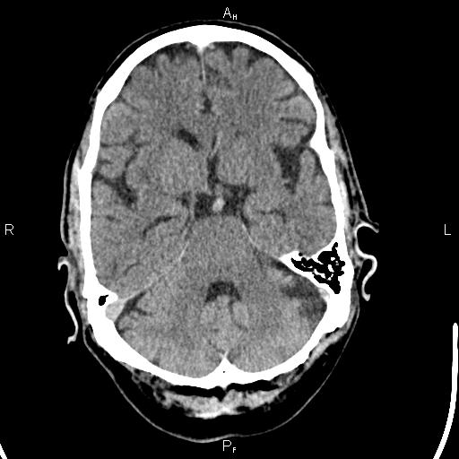 Cerebellopontine angle arachnoid cyst (Radiopaedia 85149-100704 Axial With contrast 15).jpg