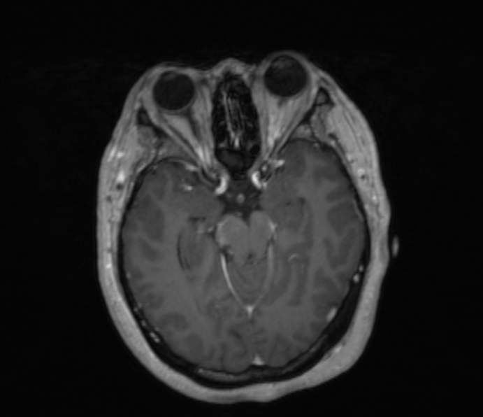 Cerebellopontine angle meningioma (Radiopaedia 35181-36715 Axial T1 C+ 34).jpg