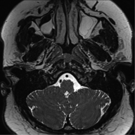 Cerebellopontine angle meningioma (Radiopaedia 48434-53348 Axial T2 Space 25).png