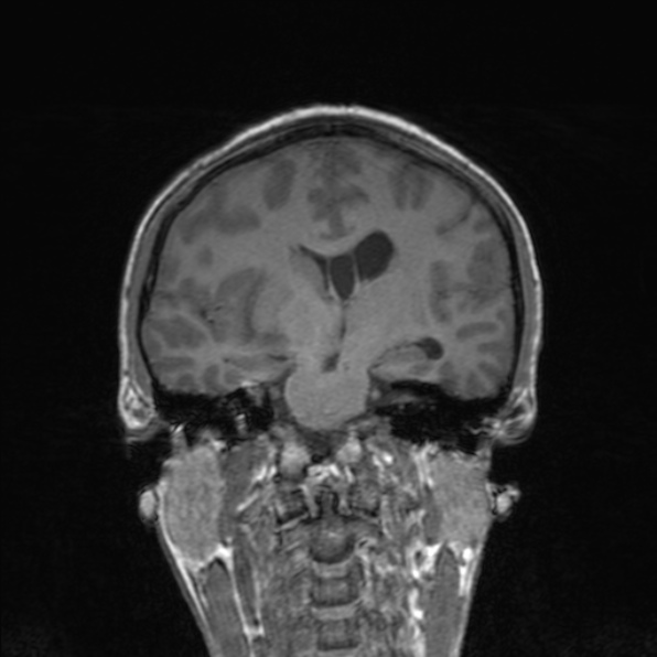 Cerebral abscess (Radiopaedia 24212-24478 Coronal T1 115).jpg