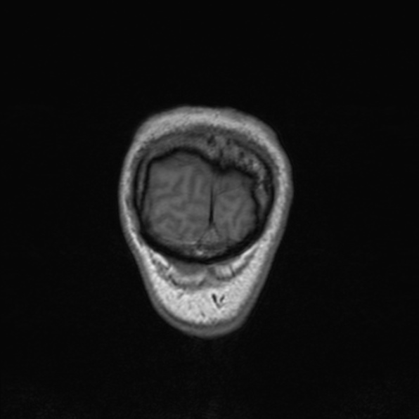 Cerebral abscess (Radiopaedia 24212-24478 Coronal T1 188).jpg