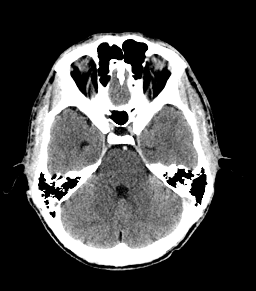 Cerebral abscess (Radiopaedia 57774-64741 Axial C+ delayed 26).png