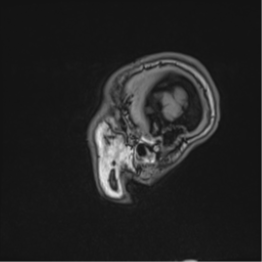 Cerebral abscess (Radiopaedia 60342-68009 Sagittal T1 8).png