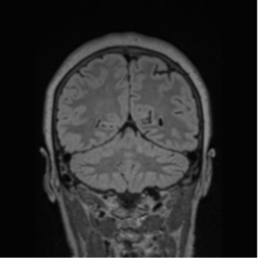 Cerebral abscess from pulmonary arteriovenous malformation (Radiopaedia 86275-102291 Coronal FLAIR 28).png