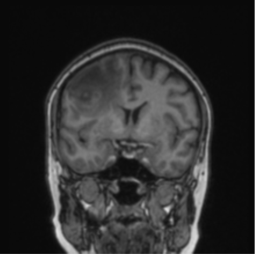 Cerebral abscess from pulmonary arteriovenous malformation (Radiopaedia 86275-102291 Coronal T1 55).png