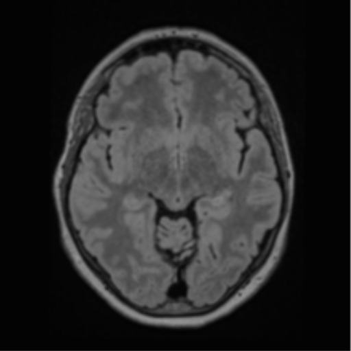 Cerebral abscess from pulmonary arteriovenous malformation (Radiopaedia 86275-102291 J 35).png