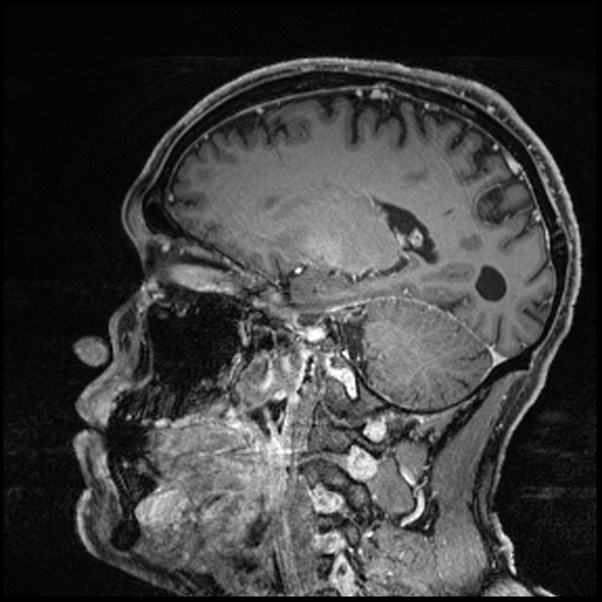 Cerebral abscess with ventriculitis (Radiopaedia 78965-91878 Sagittal T1 C+ 113).jpg