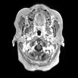 Cerebral amyloid angiopathy (Radiopaedia 29129-29518 Axial T1 C+ 15).jpg