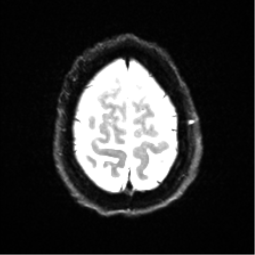 Cerebral amyloid angiopathy (Radiopaedia 46082-50433 Axial DWI 24).png